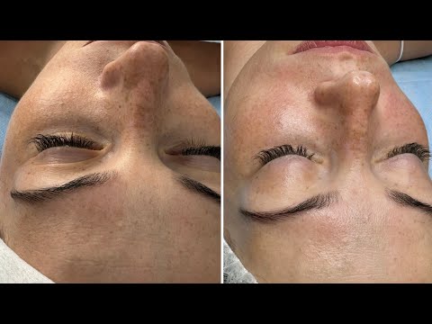 Видео: Уход за кожей лица. Протокол Glass Skin Стеклянная кожа