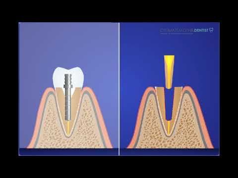 Видео: Сравнение металл и стекловолоконный штифт