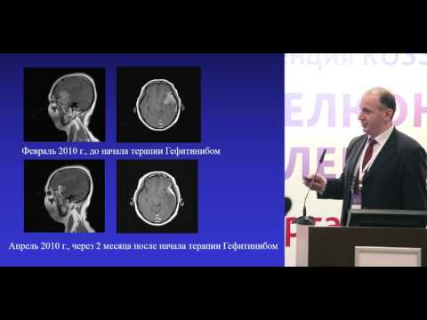 Видео: Таргетная терапия или облучение всего головного мозга при множественных церебральных метастазах НМРЛ