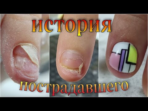 Видео: История 😳ПОСТРАДАВШЕГО ногтя /ПРОТЕЗИРОВАНИЕ