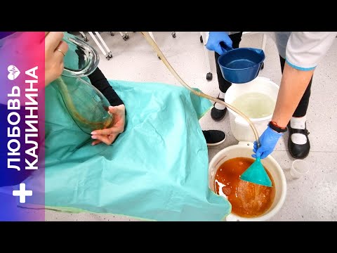 Видео: 10. Промывание желудка толстым зондом  | Л.Калинина