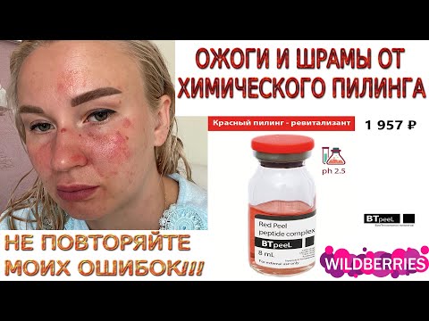 Видео: ХИМИЧЕСКИЙ ПИЛИНГ ДОМА | МОЙ ПЕЧАЛЬНЫЙ ОПЫТ