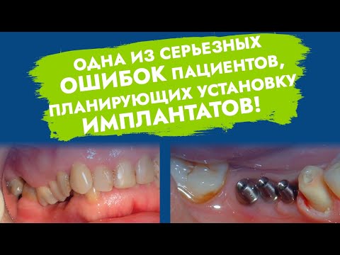 Видео: Имплантация зубов. Ошибки и осложнения.