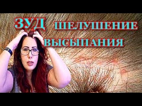 Видео: Выпадение волос/ Зуд/ Шелушение/Высыпания на коже головы/ Что делать?