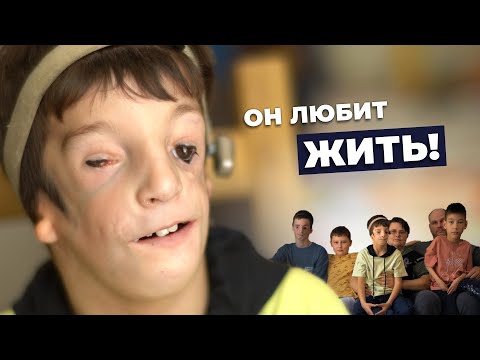 Видео: СИНДРОМ ТРИЧЕРА-КОЛЛИНЗА | История Вани Павленко