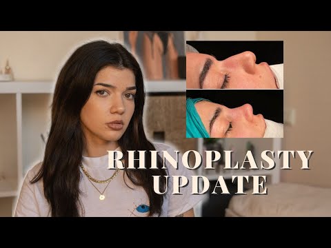 Видео: Ринопластика - година и половина по-късно