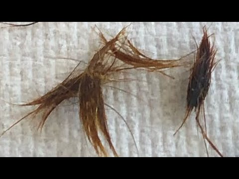 Видео: 854 - Выщипывание волос из ушей щипцами