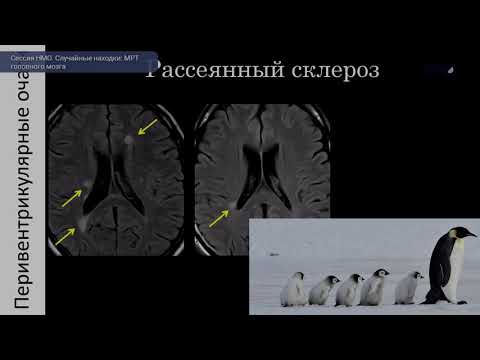 Видео: Сессия  «Случайные находки: МРТ головного мозга»