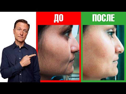 Видео: Волосы на лице женщин: главная причина. Гирсутизм и СПКЯ