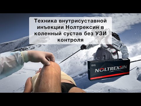 Видео: Техника внутрисуставной инъекции Нолтрексин в коленный сустав без УЗИ контроля
