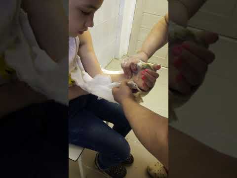 Видео: Снимают гипс