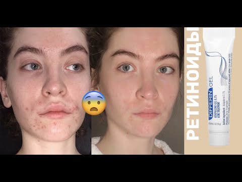 Видео: Как я вводила в уход РЕТИНОЛ от акне – adapalene 0,1%