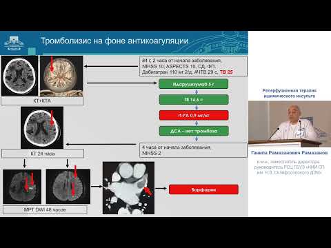 Видео: Реперфузионная терапия ишим инсульта Рамазанов Г.Р.