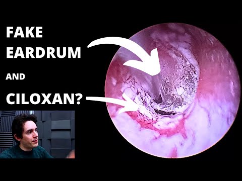 Видео: Искусственная барабанная перепонка и отсасывание остатков лекарства (Цилоксан или Цилодекс?)