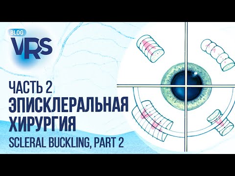 Видео: Эписклеральное пломбирование, часть 2 | Scleral buckling, part 2