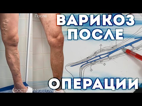 Видео: ПОЧЕМУ ВАРИКОЗ МОЖЕТ ВЕРНУТЬСЯ ПОСЛЕ ЛАЗЕРНОГО УДАЛЕНИЯ ВЕН? КОНСУЛЬТАЦИЯ
