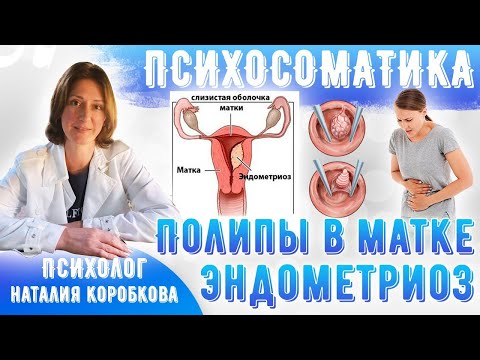Видео: Полипы в матке, гиперплазия эндометрия, эндометриоз Психосоматика.