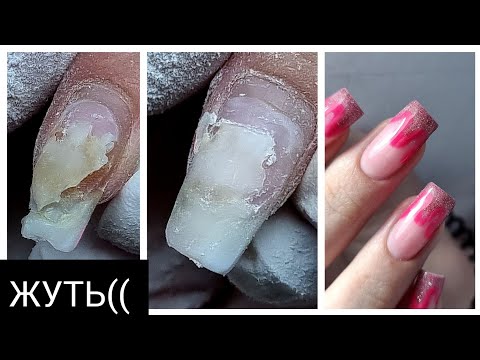 Видео: УЖАСНЫЕ отслойки(((