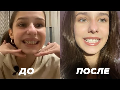 Видео: МНЕ СНЯЛИ БРЕКЕТЫ. Больно ли ставить? Как проходит процесс лечения и гигиена.