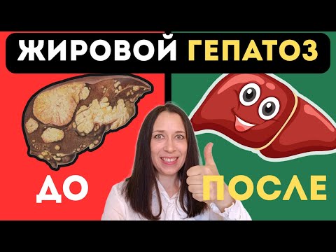 Видео: Как вылечить жировой гепатоз? 100% действующая инструкция по избавлению в 7 шагах