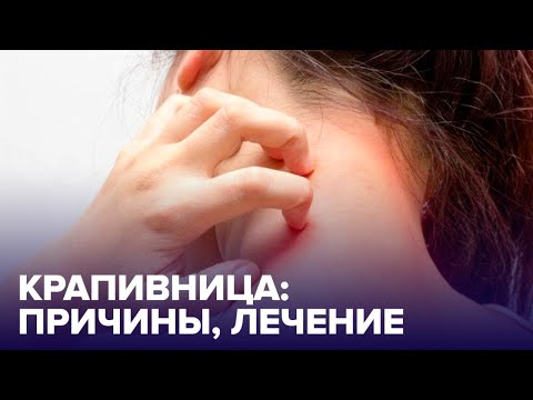 Видео: КРАПИВНИЦА: чем опасна и как ЛЕЧИТЬ