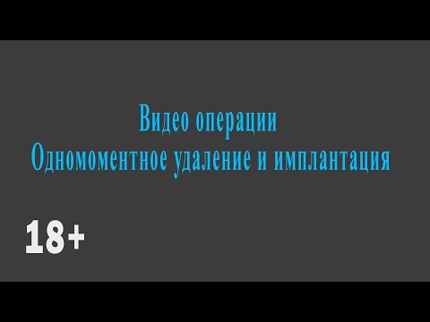 Видео: Одномоментное удаление и имплантация с немедленной нагрузкой в эстетически значимой зоне