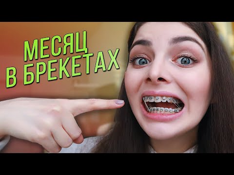 Видео: МЕСЯЦ В БРЕКЕТАХ / Изменения, Первая смена дуги