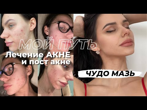 Видео: КАК Я ВЫЛЕЧИЛА ПРЫЩИ И КОМЕНДОНЫ☑️ Волшебная мазь от акне. Постакне - что делать? НЕТ Роаккутан❌