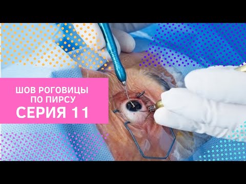 Видео: Серия 11 . Шов роговицы по Пирсу