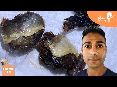 Видео: 1269 - Удаление сложного обтурирующего кератоза II степени