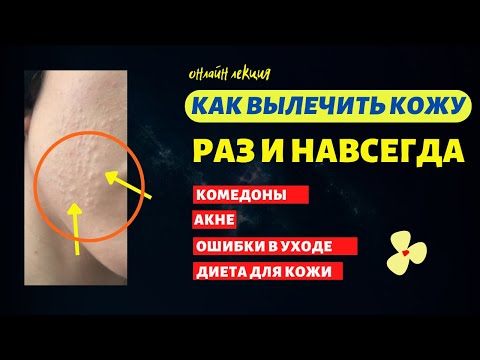 Видео: как вылечить акне | проблемная кожа у подростков | как убрать комедоны