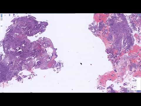 Видео: Атипическая гиперплазия эндометрия/EIN