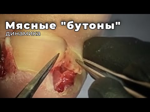 Видео: Послойное восстановление тканей и формирование нового ногтя. Вера в результат