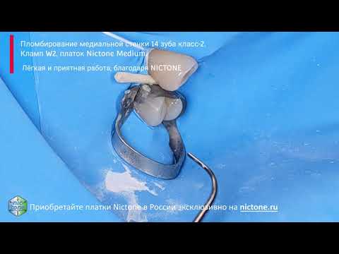 Видео: Фиксация матрицы на медиальной поверхности зуба 14 клампом W2 4K