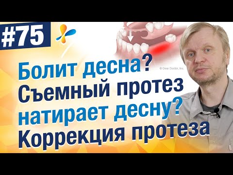 Видео: Что делать если болит десна под съемным протезом?