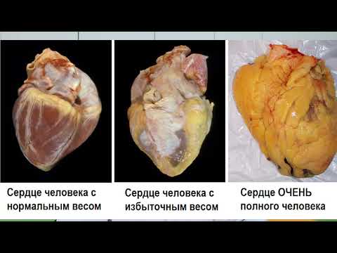 Видео: Сахарный диабет 2 типа и висцеральное ожирение.
