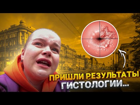 Видео: РЕЗУЛЬТАТЫ ГИСТОЛОГИИ: ПОДТВЕРДИЛАСЬ ЛИ ДИСПЛАЗИЯ ШЕЙКИ МАТКИ? ЧТО СКАЗАЛ ВРАЧ? О ВПЧ И ПОСЛЕДСТВИЯХ