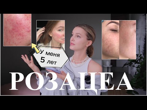 Видео: КАК я избавилась от РОЗАЦЕА | моя история лечения