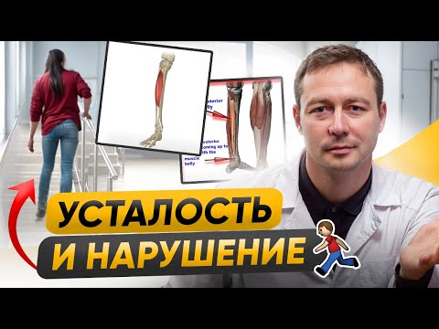 Видео: ОБОСТРЕНИЕ рассеянного склероза. Изменение походки и усталость