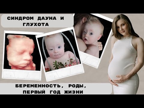 Видео: Рождение малыша с синдромом Дауна и глухотой. Беременность. Роды. Начало пути