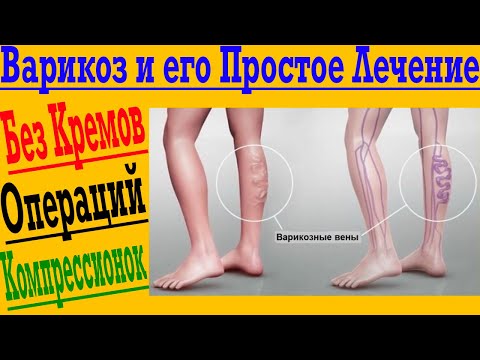 Видео: Варикоз и его простое лечение!
