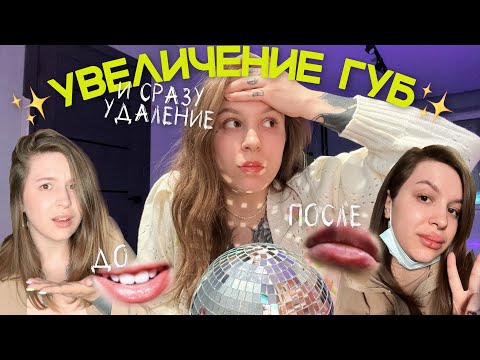 Видео: Мой УЖАСНЫЙ опыт увеличения губ ✦ УДАЛЕНИЕ губ гиалуронидазой ✸