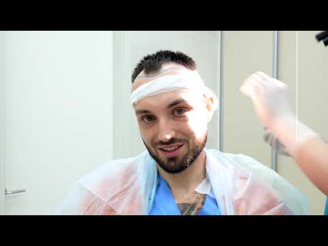 Видео: Дневник одной пересадки волос