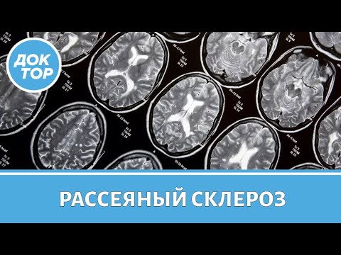 Видео: По каким симптомам можно заподозрить развитие рассеянного склероза