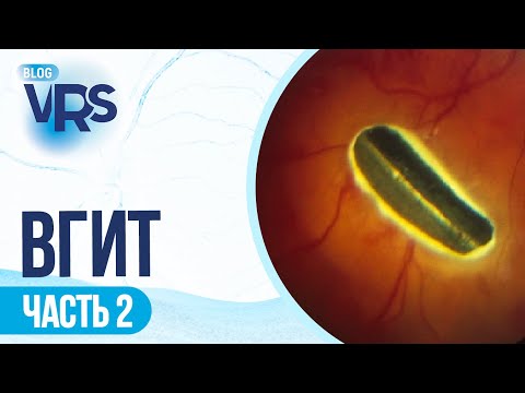 Видео: Травма глаза / Внутриглазные инородные тела