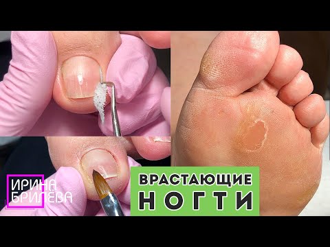 Видео: ПЕДИКЮР 🌸 Толстые ногти, склонные к врастанию 🌸 Треснувший ноготь и его ремонт 🌸 Ирина Брилёва