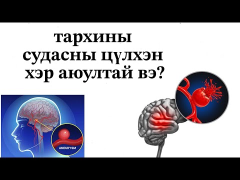 Видео: тархины судасны цүлхэн ямар хүмүүст их үүсдэг вэ?