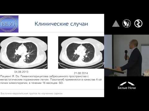 Видео: Успехи, достижения в лекарственной терапии сарком мягких тканей