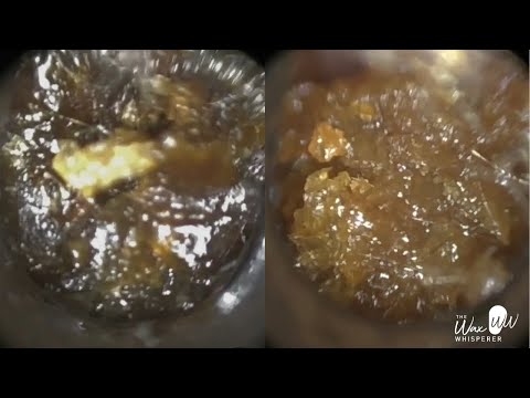 Видео: 148 - Невероятное количество ушной серы, удаленное у плачущего 7-летнего ребенка с помощью WAXsco...