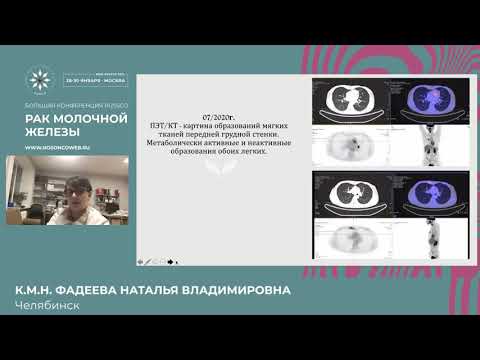 Видео: Современные подходы к лечению тройного негативного рака и реальная клиническая практика